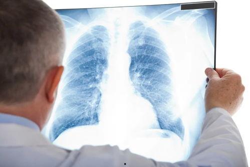 科兴员工爆料肺结节视频,揭示疫苗生产员工健康隐患 第3张 科兴员工爆料肺结节视频,揭示疫苗生产员工健康隐患 第3张
